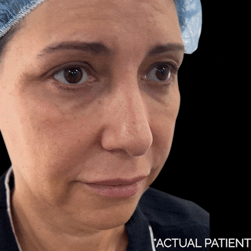 Aging Face before and after photos by Noses and Necks NYC in New York, NY