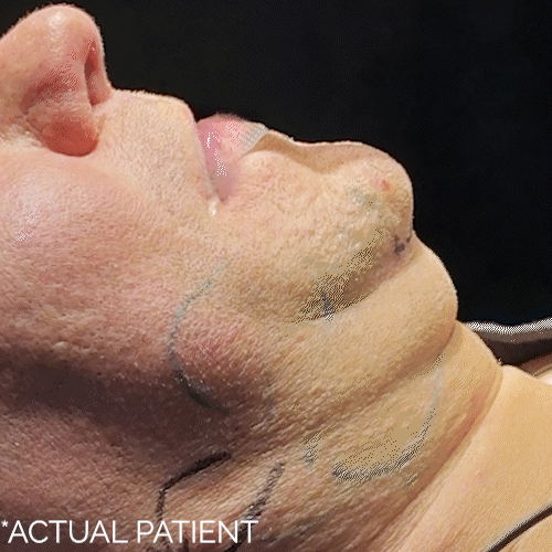 Aging Face before and after photos by Noses and Necks NYC in New York, NY
