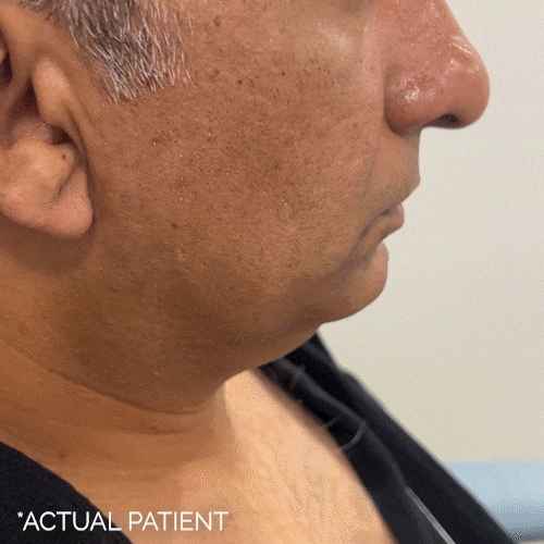 Aging Face before and after photos by Noses and Necks NYC in New York, NY