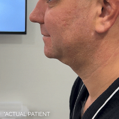Aging Face before and after photos by Noses and Necks NYC in New York, NY
