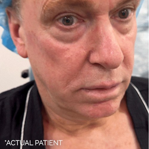 Actual male blepharoplasty patient of Anil R. Shah MD FACS