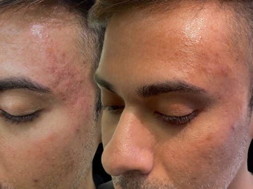 acne scarring before after gallery preview acne scarring before after gallery preview