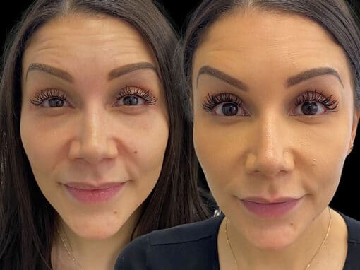 botox before after gallery preview botox before after gallery preview