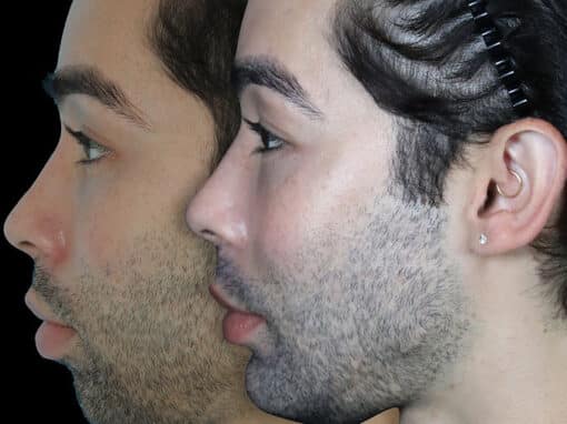 chin implant before after gallery preview chin implant before after gallery preview