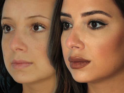 lip fillers before after gallery preview lip fillers before after gallery preview