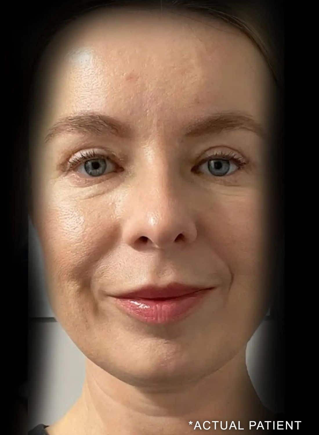 Lower eyelid surgery