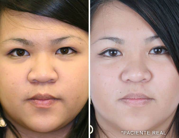 paciente real asian rhinoplasty pictures