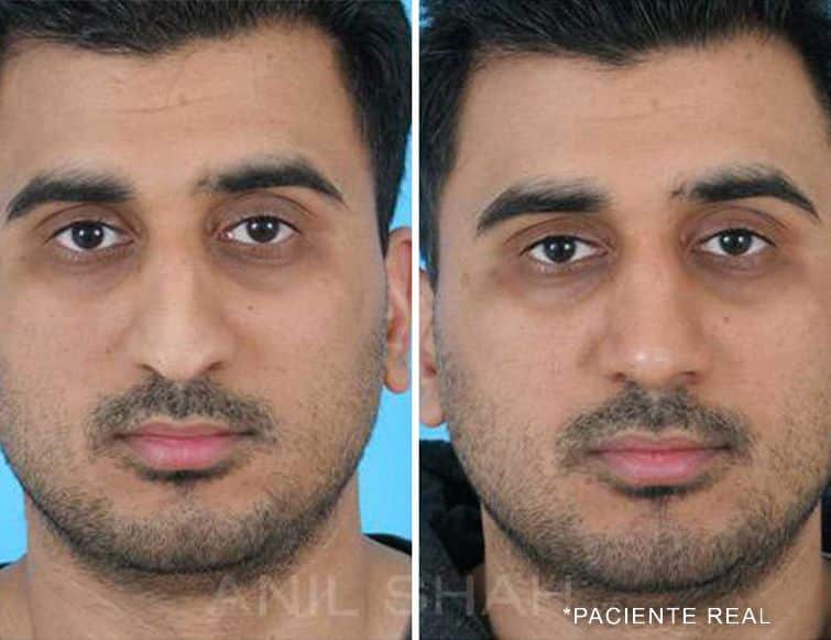 paciente real indian rhinoplasty pictures