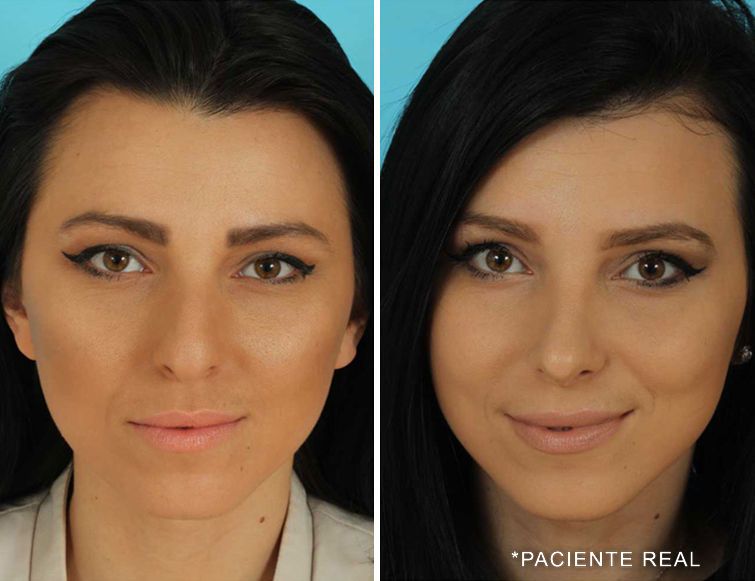 paciente real middle eastern rhinoplasty pictures