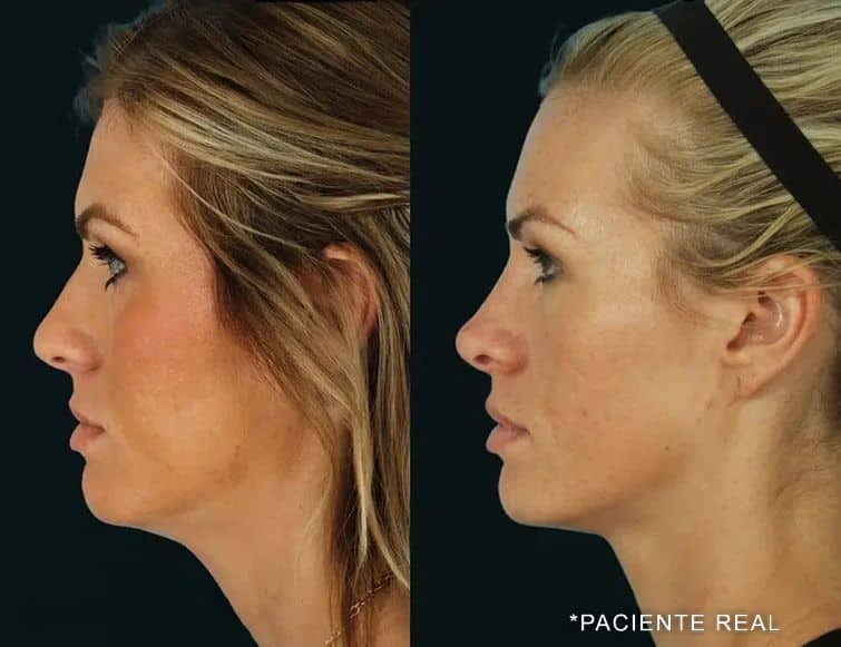 paciente real rhinoplasty before and after photos by noses and necks nyc in new york ny
