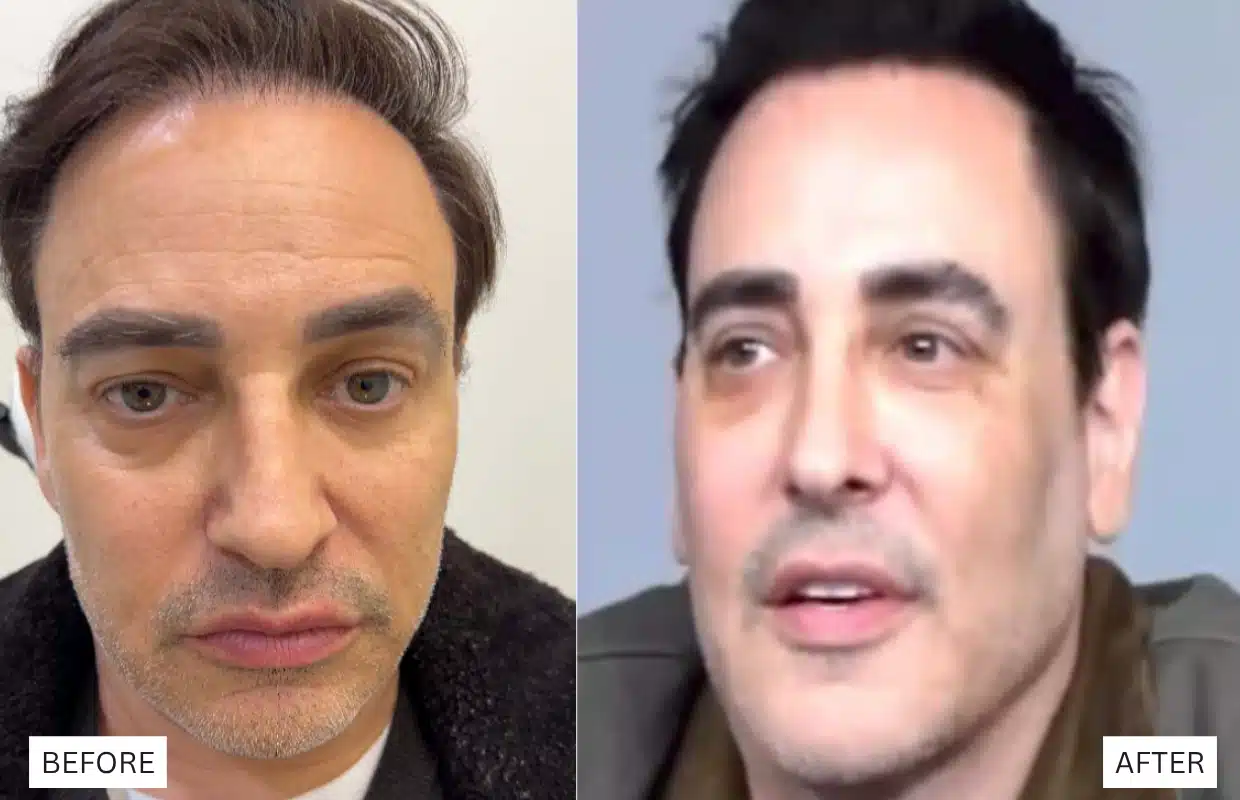 eric himel before and after blepharoplasty