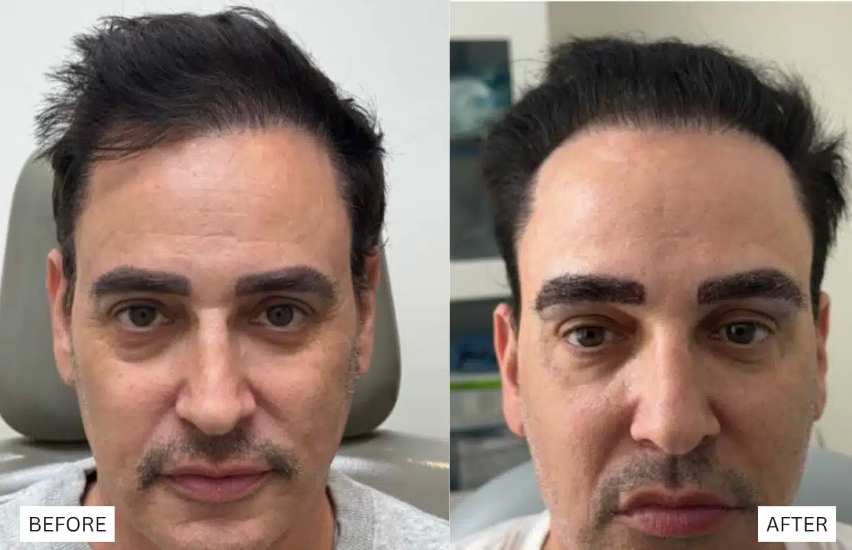 eric himel before and after hair restoration